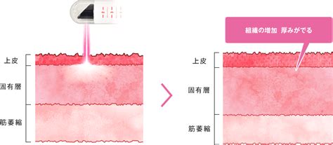 Gショット（感度UP手術）